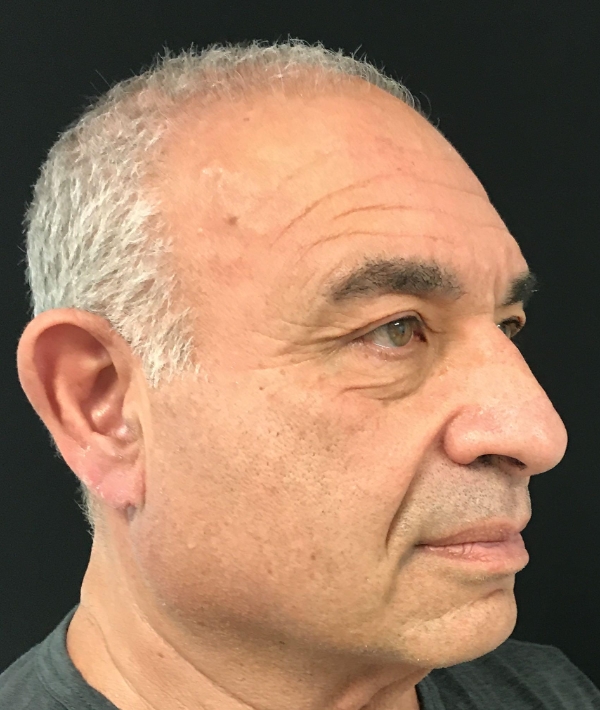 Before